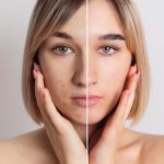 LED light therapy face lift before after results showing complete facial rejuvenation and improved firmness