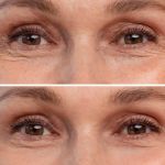 LED light therapy before after showing reduced under-eye wrinkles and fine lines around eyes