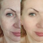 LED light therapy before after results showing refined pores and smoother skin texture