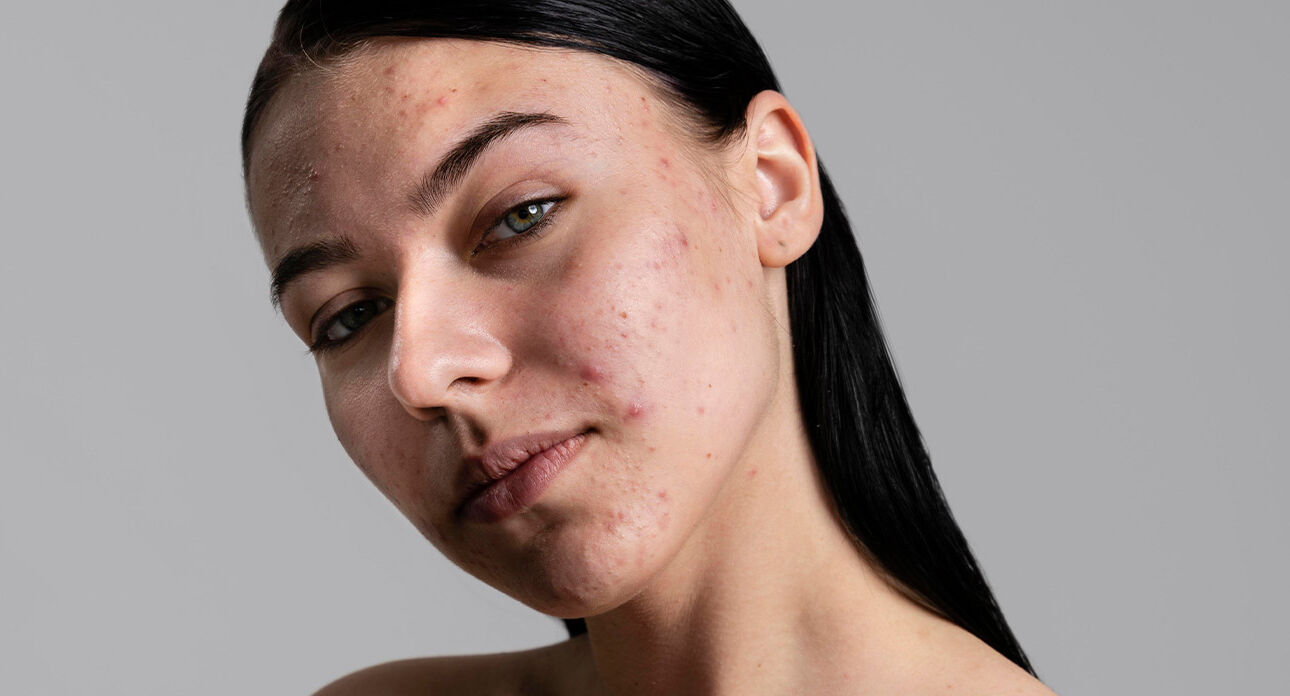 From Acne to Aging: How FiberLift LED Light Supports Every Skin Goal